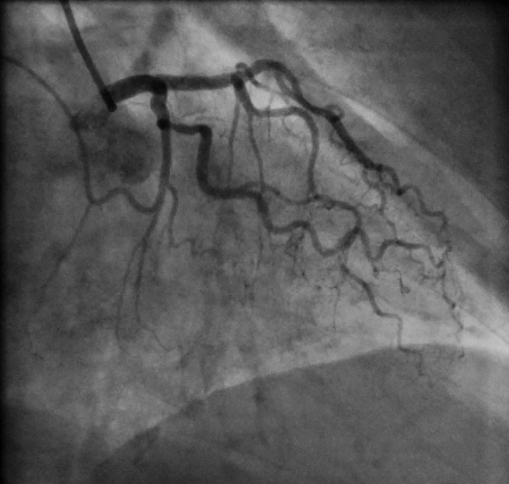 Cardiac Angiography (Cardiac Catheterization)
